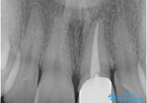 【歯周外科】審美的に気になる短い前歯の長さを歯茎の外科手術とセラミックで揃えるの治療前