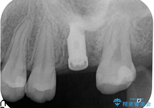 奥歯が割れてしまった! → インプラントによるかみ合わせの回復の治療中