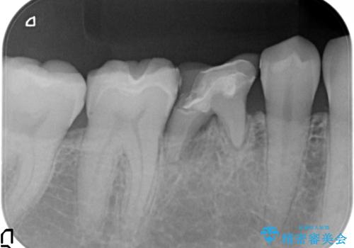 残せなくなってしまった乳歯 インプラントによる補綴の治療前