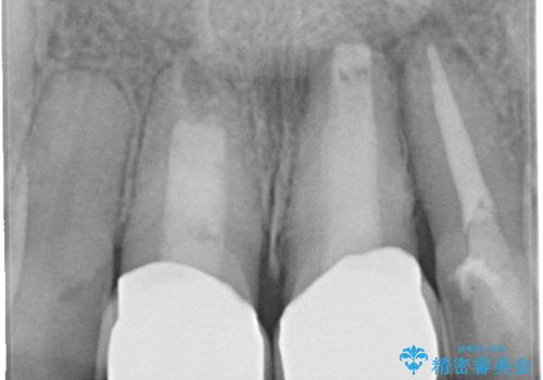 変色した前歯をセラミックできれいに レイヤリングセラミックの治療後