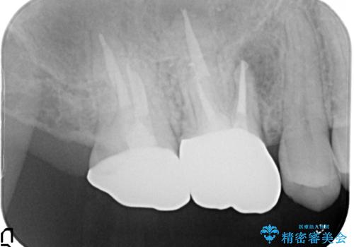 根っこの感染 再治療をしてかぶせ物を製作するの治療後