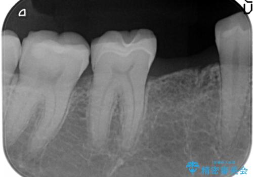 残せなくなってしまった乳歯 インプラントによる補綴の治療中