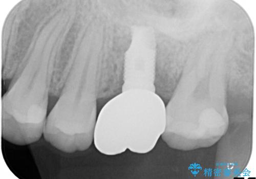 奥歯が割れてしまった! → インプラントによるかみ合わせの回復の治療後