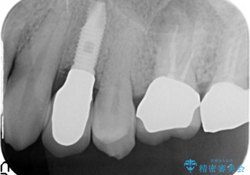 歯がわれた　抜歯してインプラント　50代男性の治療後