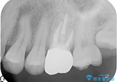 金属の奥歯　→　白い奥歯　根管治療からのやり直しの治療後