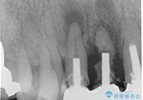 矯正を併用した前歯のセラミックブリッジ治療の治療前