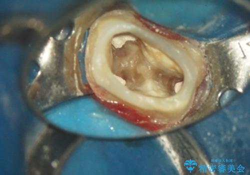 金属の奥歯　→　白い奥歯　根管治療からのやり直しの治療中