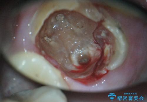 奥歯が割れてしまった! → インプラントによるかみ合わせの回復の治療中