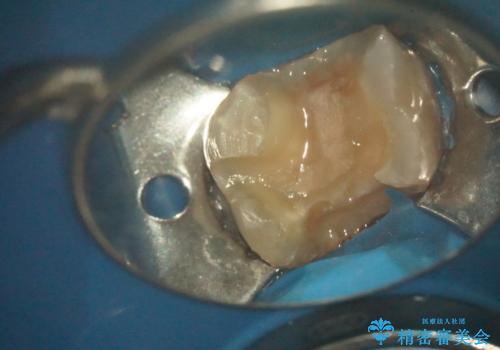 感染した奥歯 痛くて咬めない 根管治療→かぶせ物で痛みを取り除き、かみ合わせを回復するの治療中