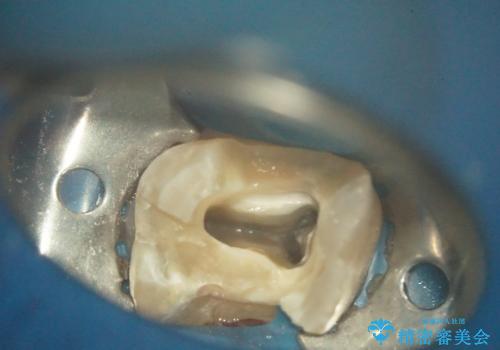 感染した奥歯 痛くて咬めない 根管治療→かぶせ物で痛みを取り除き、かみ合わせを回復するの治療中