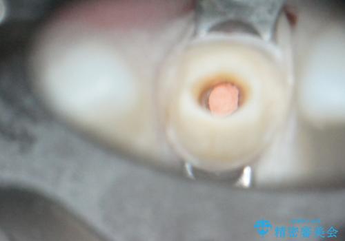 【歯周外科】審美的に気になる短い前歯の長さを歯茎の外科手術とセラミックで揃えるの治療中