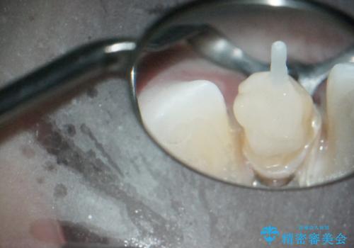 【歯周外科】審美的に気になる短い前歯の長さを歯茎の外科手術とセラミックで揃えるの治療中