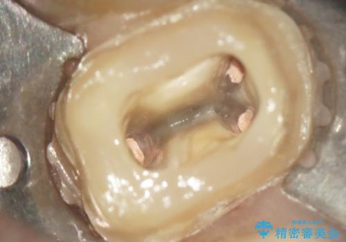 感染した奥歯 痛くて咬めない 根管治療→かぶせ物で痛みを取り除き、かみ合わせを回復するの治療中