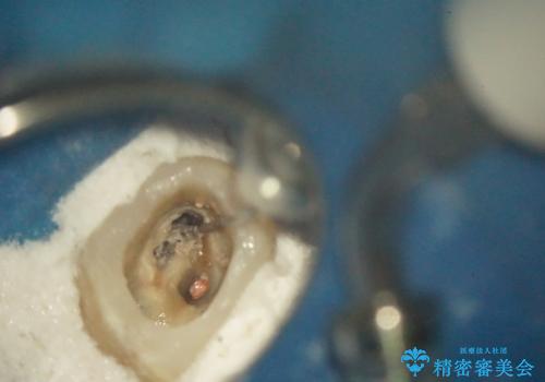 根っこの感染 再治療をしてかぶせ物を製作する