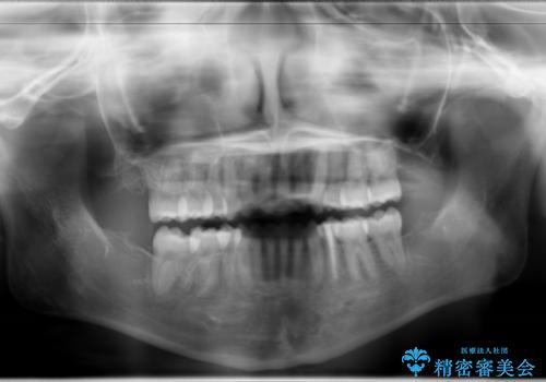 ハーフリンガル　半分裏側矯正による上下前突の抜歯矯正治療の治療後