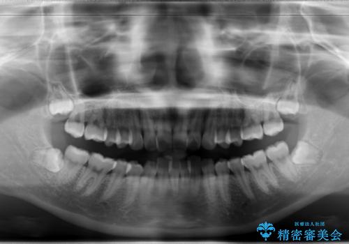 Invisalign インビザラインによる軽度なガタつきの改善の治療前