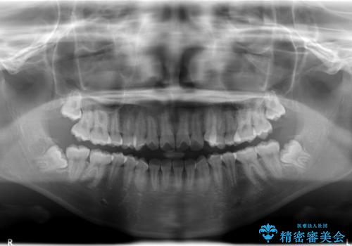 ハーフリンガル 半分裏側矯正による上下前突の抜歯矯正治療の治療前