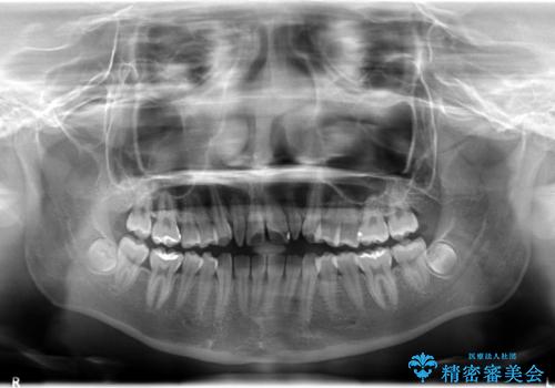 歯の形態修正も含めた矯正治療&セラミック治療の治療前