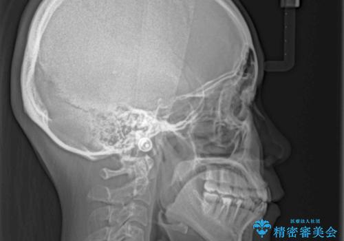 反対咬合を治したい インビザラインによる矯正治療の治療前