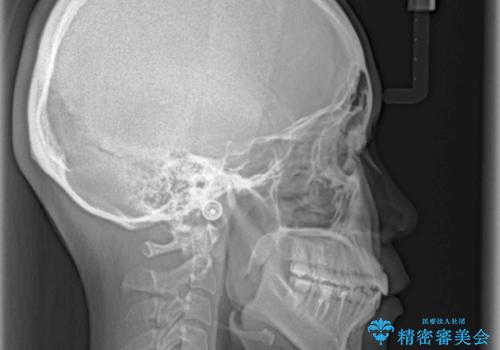 反対咬合を治したい インビザラインによる矯正治療の治療後