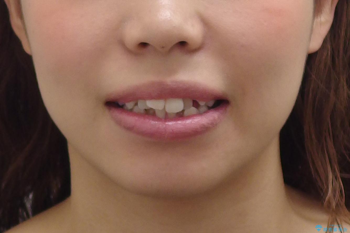 八重歯 抜かずにマウスピース矯正治療の治療前(顔貌)