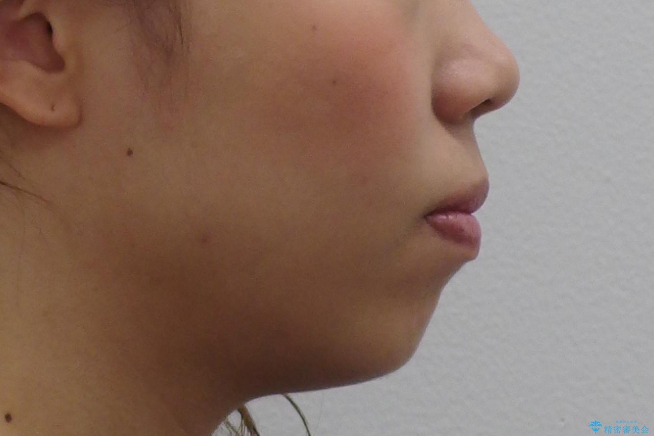 八重歯 抜かずにマウスピース矯正治療の治療前(顔貌)