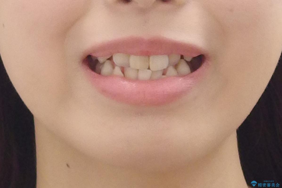 八重歯 前歯のがたがた 抜歯してワイヤー矯正の治療前(顔貌)