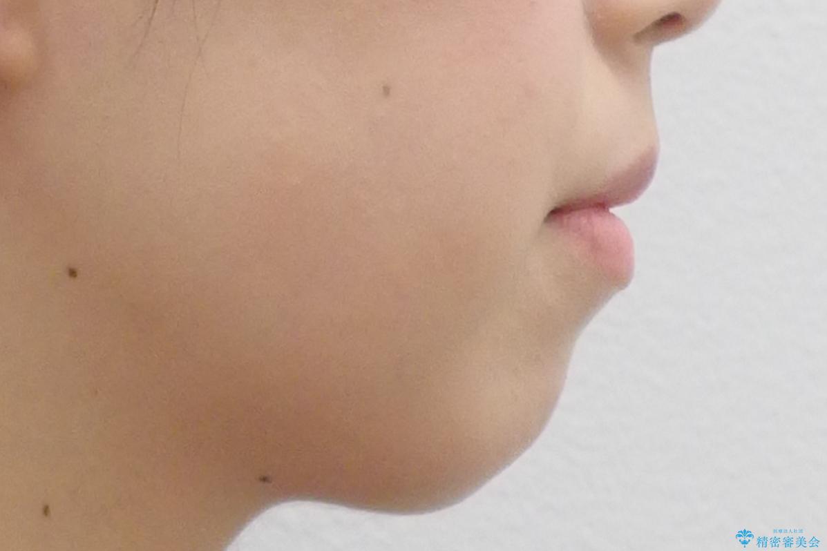 八重歯 前歯のがたがた 抜歯してワイヤー矯正の治療前(顔貌)