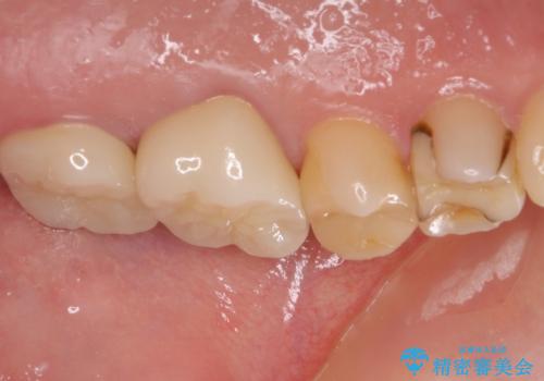 奥歯のクラウン周りが腫れる　精密治療による腫脹の改善の治療後