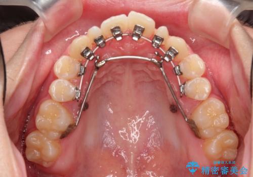 歯の形態修正も含めた矯正治療&セラミック治療