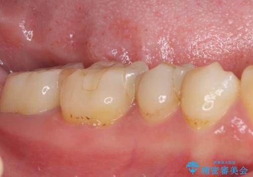 奥歯のクラウン周りが腫れる　精密治療による腫脹の改善の治療後