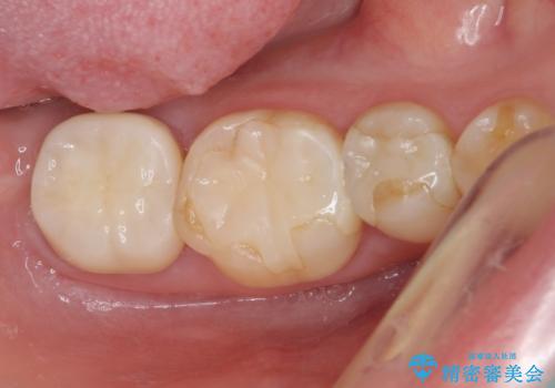 奥歯のクラウン周りが腫れる　精密治療による腫脹の改善