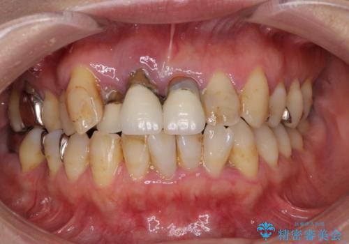 矯正を併用した前歯のセラミックブリッジ治療の症例 治療前