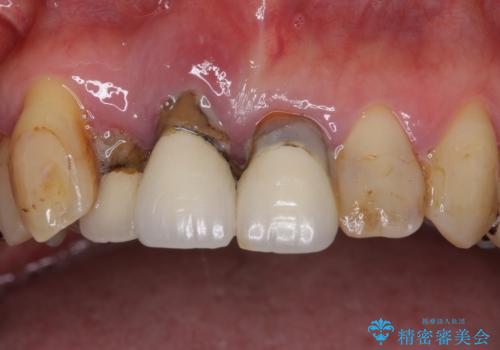 矯正を併用した前歯のセラミックブリッジ治療の治療前