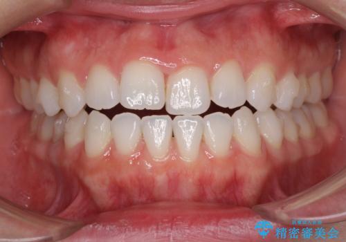 反対咬合を治したい インビザラインによる矯正治療の治療中