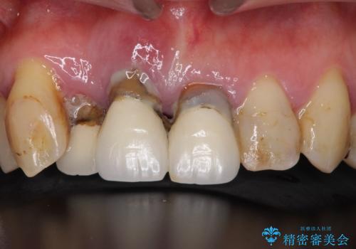 矯正を併用した前歯のセラミックブリッジ治療の治療前