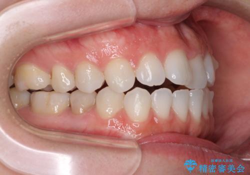 反対咬合を治したい インビザラインによる矯正治療の治療中