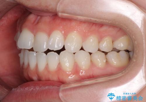 反対咬合を治したい インビザラインによる矯正治療の治療中