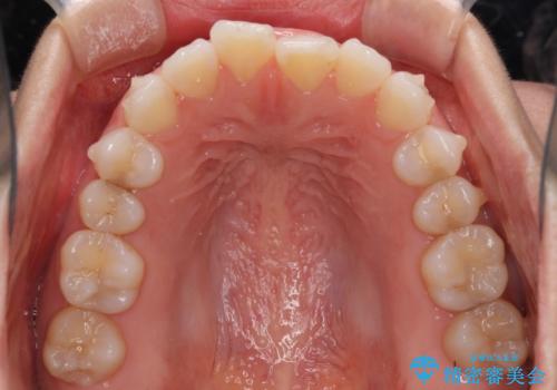 反対咬合を治したい インビザラインによる矯正治療の治療中