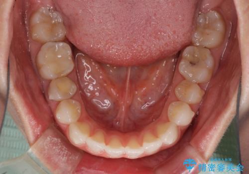 反対咬合を治したい インビザラインによる矯正治療の治療中