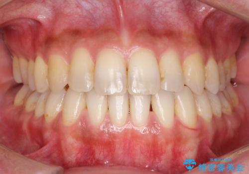 Invisalign インビザライン によるガタつき、受け口傾向の改善