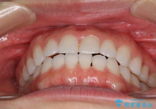 反対咬合を治したい インビザラインによる矯正治療の治療後