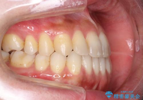 Invisalign インビザライン によるガタつき、受け口傾向の改善の治療後