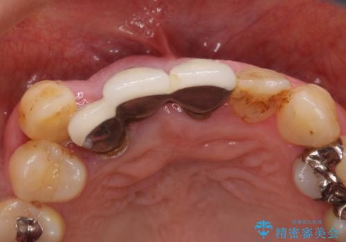 矯正を併用した前歯のセラミックブリッジ治療の治療前