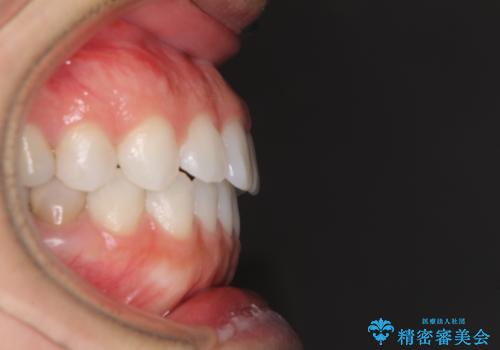 反対咬合を治したい インビザラインによる矯正治療の治療後