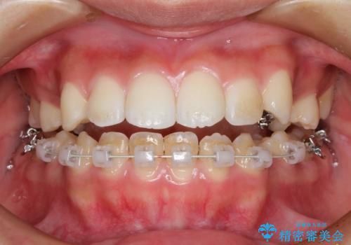 ハーフリンガル 半分裏側矯正による上下前突の抜歯矯正治療の治療中