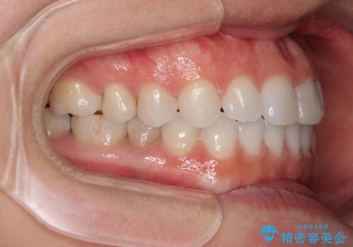 反対咬合を治したい インビザラインによる矯正治療の治療後