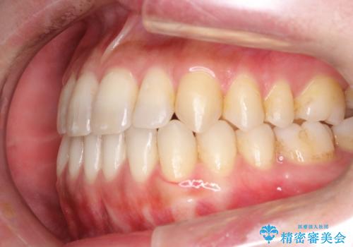 Invisalign インビザライン によるガタつき、受け口傾向の改善の症例 治療後