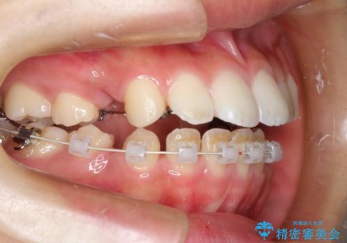 ハーフリンガル 半分裏側矯正による上下前突の抜歯矯正治療の治療中