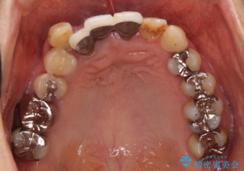 矯正を併用した前歯のセラミックブリッジ治療の治療前